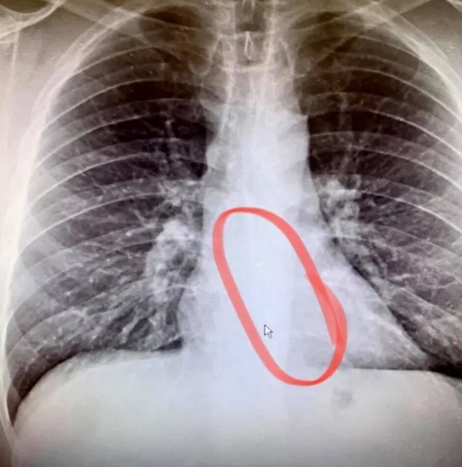La radiografía tomada en el hospital muestra el AirPod perdido en el esófago de Gauthier - PSA: Nunca use sus AirPods antes de acostarse; he aquí por qué 